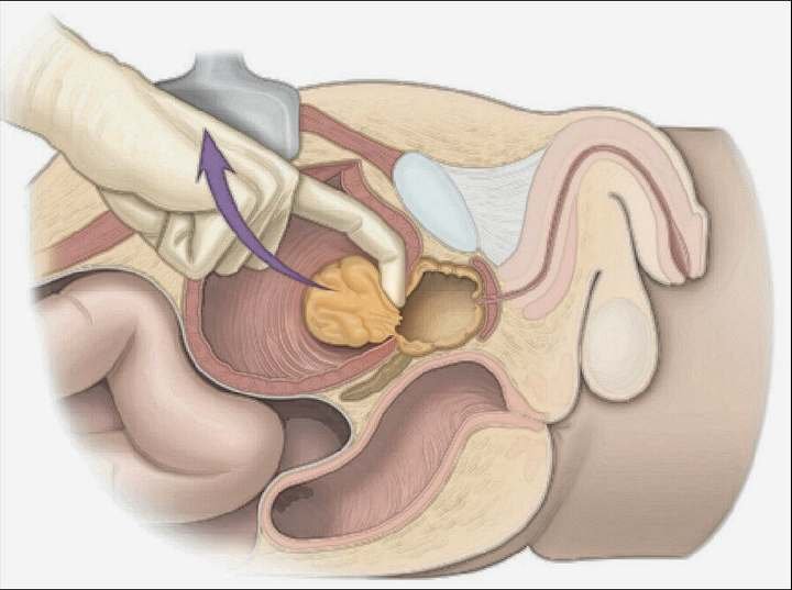 Adenomectomia