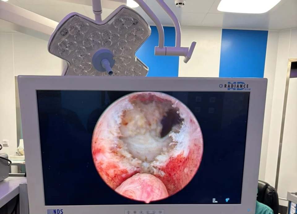 Imagen endoscópica en un monitor del quirófano durante el curso de endourología