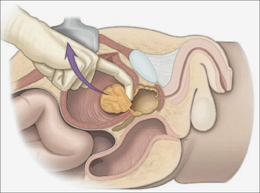 Adenomectomia
