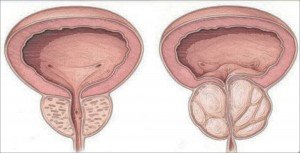 Próstata normal frente a próstata agrandada, la referencia de los grados de hiperplasia prostática