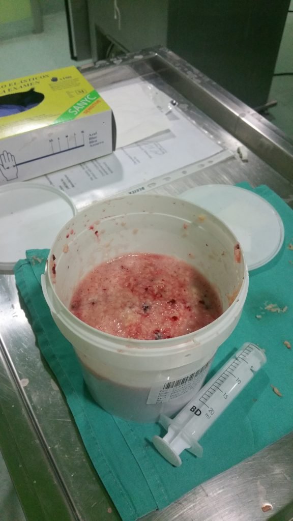 Enucleación con láser holmium de próstata de 500cc. NUEVO RECORD