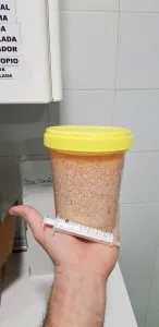Enucleacion de prostata de 650 g. ¿Alguien da más